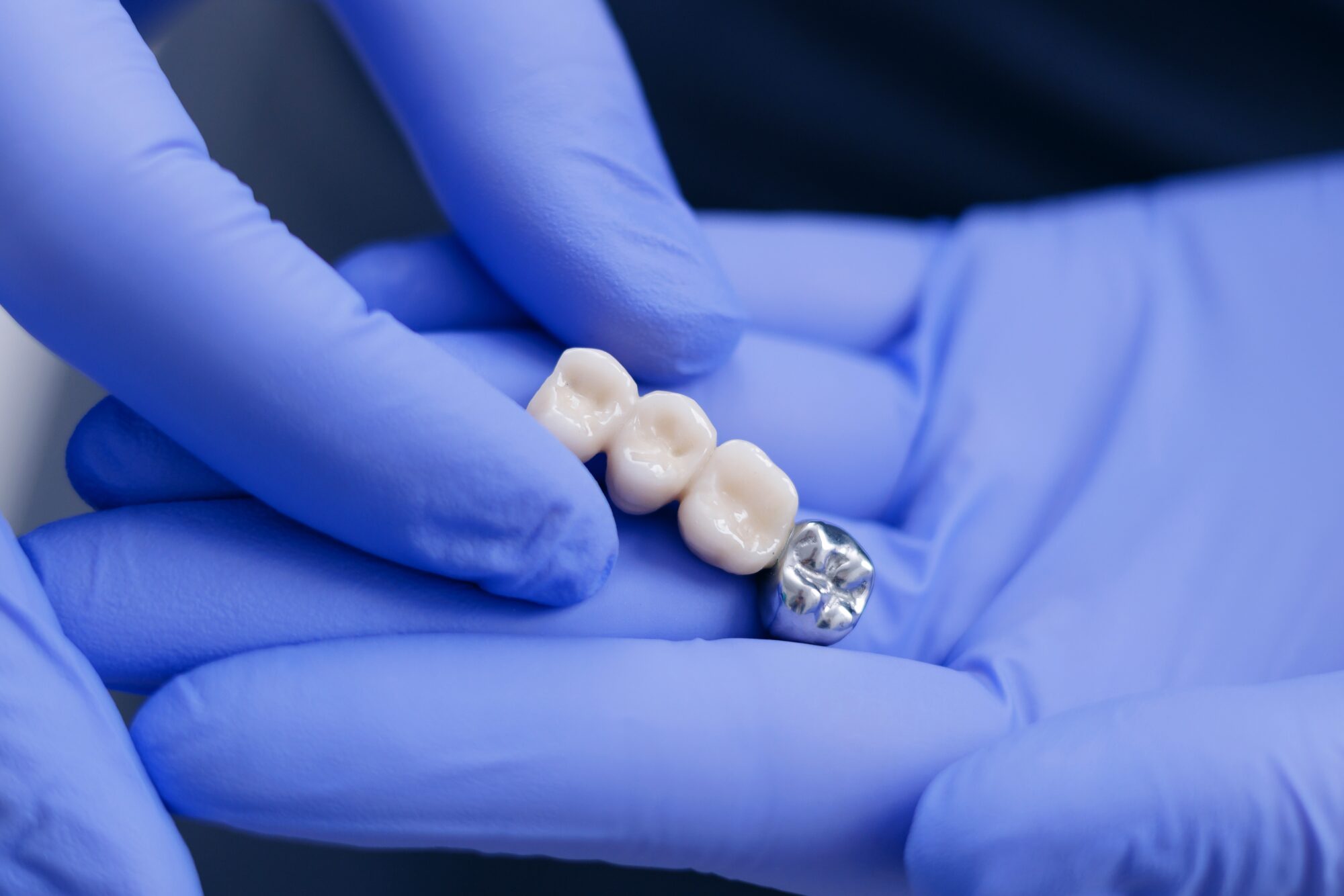 dental crown in land o' lakes fl