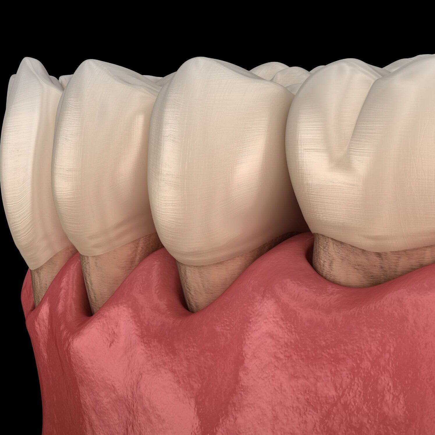 Gum Disease Example Close up shot on a model of teeth showing gum disease