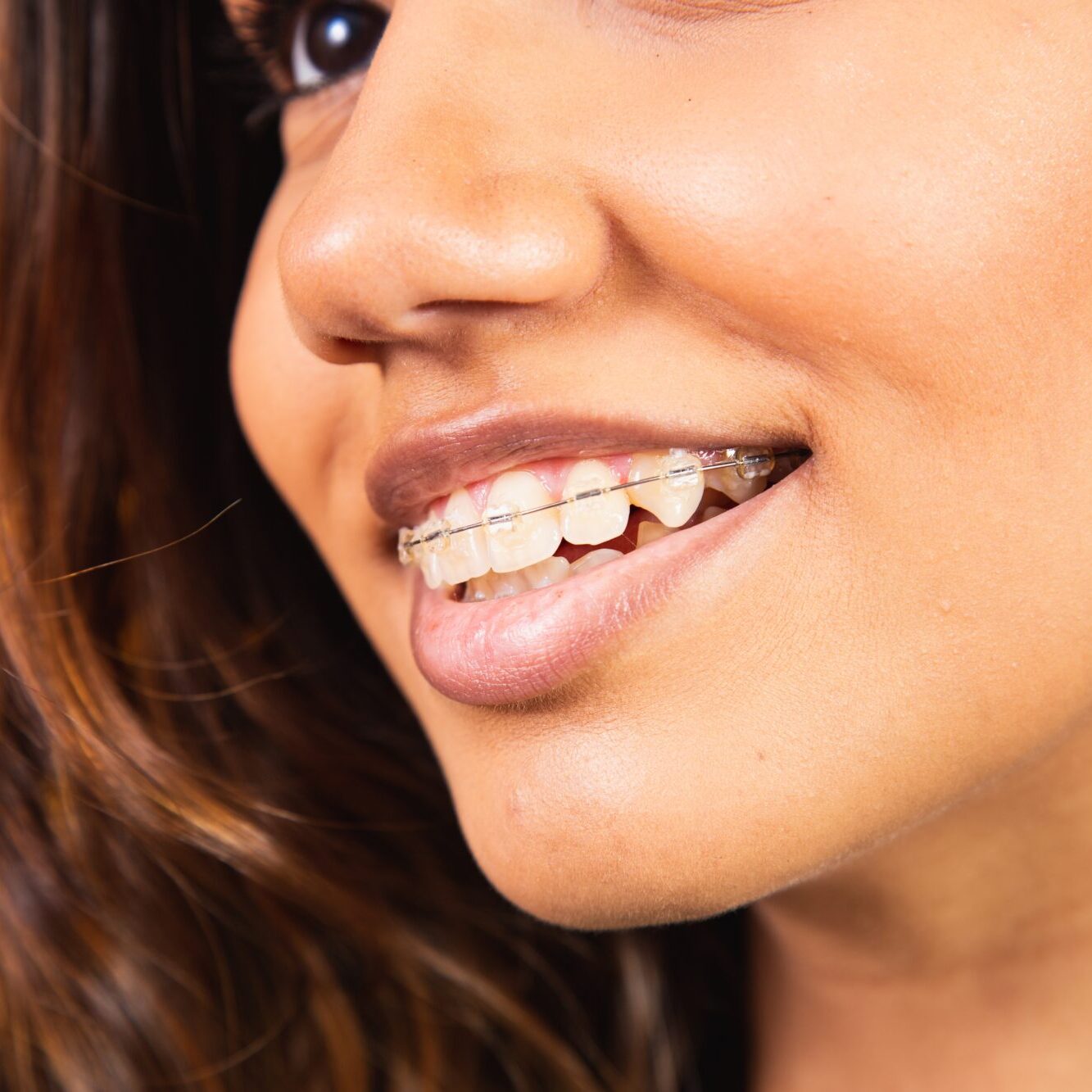 Closeup,Of,Smiling,Young,Woman,With,Transparent,Braces.,Dental,Treatment